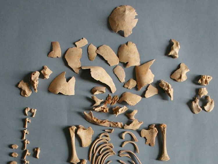 Overblijfselen van mens “CRU001” uit de ijzertijd. Onderzoekers ontdekten dat het het syndroom van Down had.