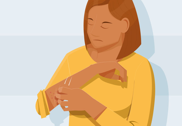 Van schurft krijg je jeuk en uitslag. Met zalf of pillen is het goed te behandelen.